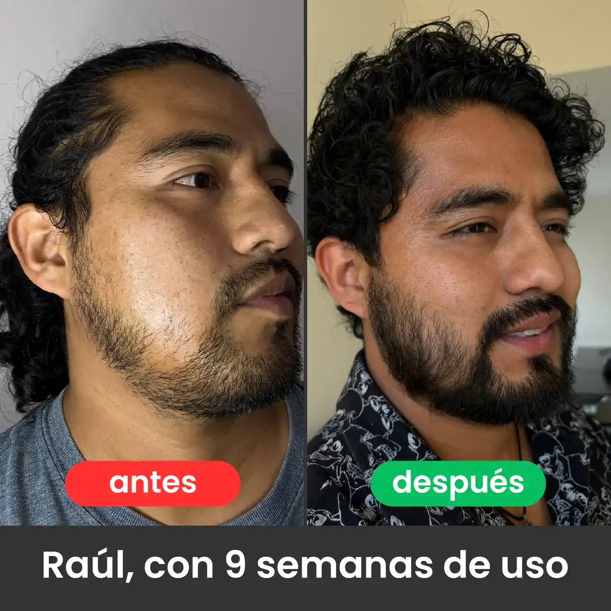 BARVAN™ - Bálsamo para Crecimiento de Barba (Minoxidil 20%)